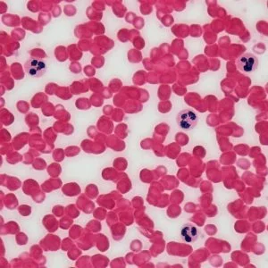 Células do sangue ao microscópio - Painel de linfoma hereditário